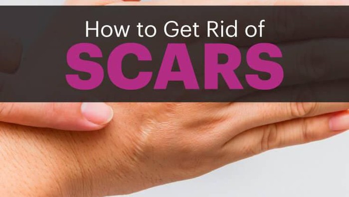 Bekas Luka Cepat Hilang dengan Bahan Alami