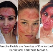 Ladies! Berani Cobain 'Vampire Facial' yang Serem tapi Sukses Bikin Kulit Muda Bak Selebritis Dunia?