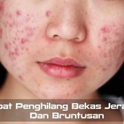 Gimana Sih Cara Menghilangkan Jerawat dan Bruntusan Akibat Salah Produk?
