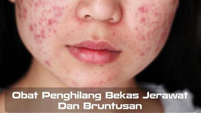 Gimana Sih Cara Menghilangkan Jerawat dan Bruntusan Akibat Salah Produk? Gimana Sih Cara Menghilangkan Jerawat dan Bruntusan Akibat Salah Produk?