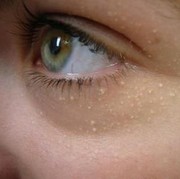 Ada enggak sih krim yang bisa menghilangkan bruntusan kecil di wajah?