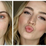 Wah, Obat Tetes Mata Ternyata Ampuh Redakan Jerawat Kemerahan Secara Cepat!