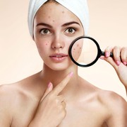 Help me ladies! Berapa Lama Sih Biasanya Proses Kulit Purging Berlangsung?