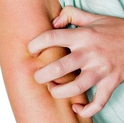 Bagaimana cara menghilangkan bekas luka gigitan nyamuk?