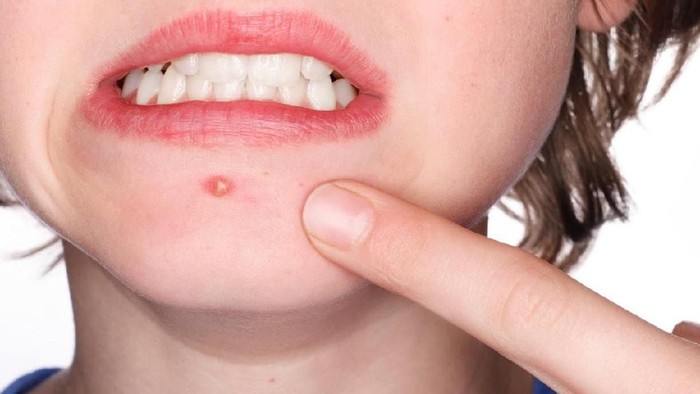 Duh Ladies, Ternyata 5 Faktor Ini Jadi Penyebab Jerawat Batu Muncul Mendadak di Wajah Kamu!