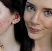 Kosmetik yang Perlu Dihindari untuk Wajah Berjerawat