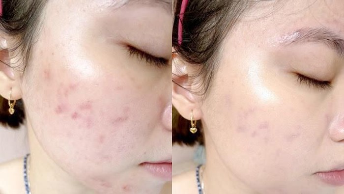 Ini Lho Rekomendasi Skincare Korea yang Ampuh Banget Menghilangkan Bekas Jerawat! Ini Lho Rekomendasi Skincare Korea yang Ampuh Banget Menghilangkan Bekas Jerawat!