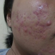 [FORUM] HELP! Bekas Jerawat Merah Kehitaman