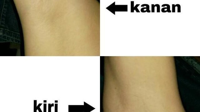 [FORUM] Kelainan hormon atau apa? Menurut kamu aneh gak sih usia >20 tahun tapi belum tumbuh bulu ketiak?