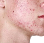 [FORUM] Udah pada denger tentang jerawat pasir belum?