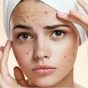 [FORUM] Obat jerawat andalan kalian apa shay?