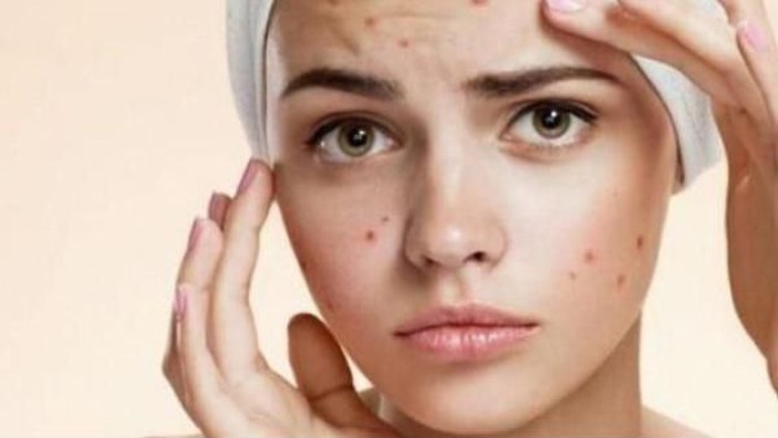 [FORUM] Obat jerawat andalan kalian apa shay?