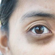 [FORUM] Gimana cara hilangin mata panda dan kerutan dibawah mata yang paling ampuh?