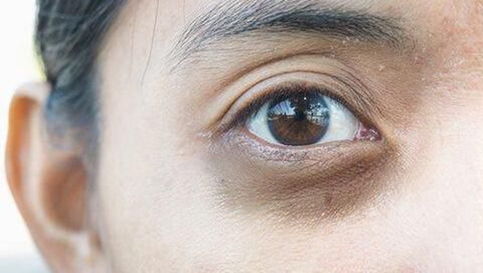 [FORUM] Gimana cara hilangin mata panda dan kerutan dibawah mata yang paling ampuh?