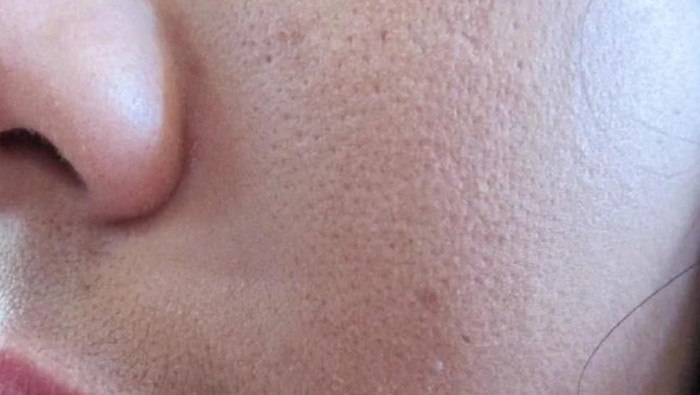 [FORUM] Pakai lemon, pori-pori malah membesar?!