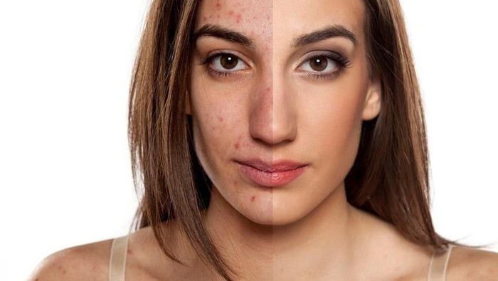 Cara Ampuh Menghilangkan Bekas Luka di Wajah dengan Masker Alami