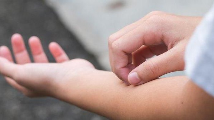 [FORUM] kalo udah pernah kena cacar katanya gak bakal kena lagi, beneran gak sih....