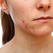 [FORUM] Rekomendasi obat untuk bekas jerawat dong gengggs