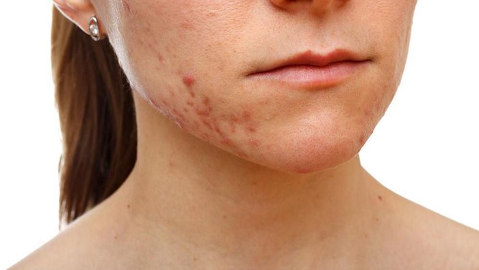 [FORUM] Rekomendasi obat untuk bekas jerawat dong gengggs