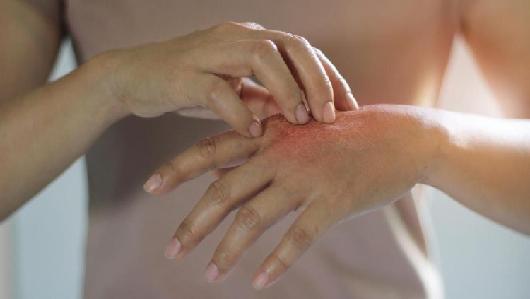 Gadis bernama Rajeshwari mengalami mutasi genetik yang menyebabkan kelainan kulit. Tubuh Rajeshwari dipenuhi lepuhan dan sisik yang berwarna abu-abu dan keras.