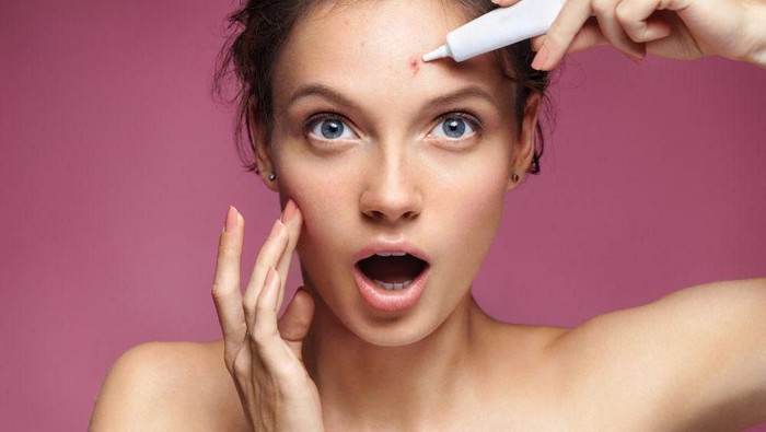 Bingung Menghadapi Jerawat Batu? Coba 5 Cara Alami Berikut!