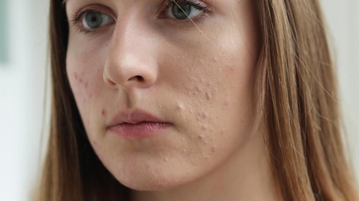 Bruntusan? Coba Campuran Bahan Alami Ini