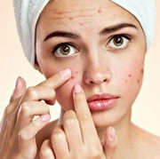 Ladies Hobi Memencet Jerawat? Waspada, Ini Bahaya yang Mengancam!