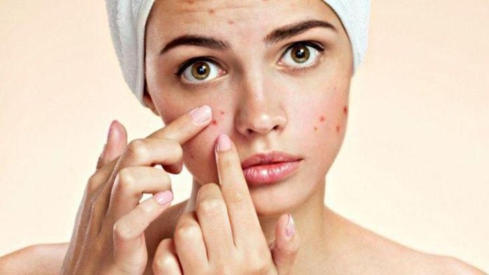 Ladies Hobi Memencet Jerawat? Waspada, Ini Bahaya yang Mengancam!