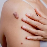 Keloid, Apa Itu dan Bagaimana Perawatannya di Rumah?