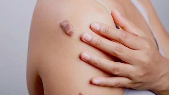 Keloid, Apa Itu dan Bagaimana Perawatannya di Rumah?