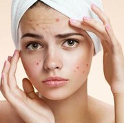 Bingung Banget Cari Cara Ampuh Ngatasin Jerawat dan Bikin Kulit Halus, Ada Ide Gak Sih?