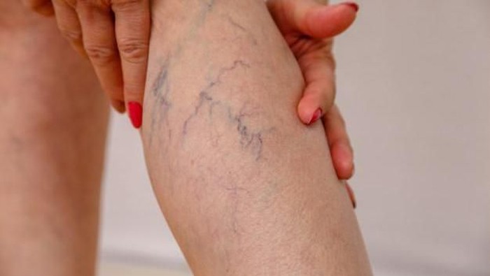 Spider Veins Mengganggu? Singkirkan dengan Bahan Alami Ini!
