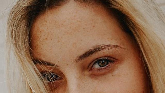 5 Jenis Jerawat Ini Sering Muncul di Kulitmu, Tahu Bedanya?