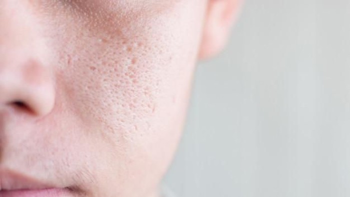 Pori-pori Wajah Besar? Ini Penyebab dan Cara Mengatasinya!