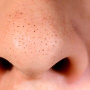 Jerawat di Hidung Sering Bikin Keki, Atasi Aja dengan Cara Ini!