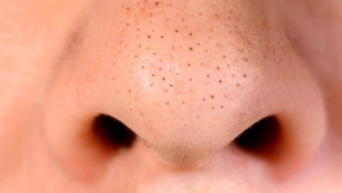 Jerawat di Hidung Sering Bikin Keki, Atasi Aja dengan Cara Ini!