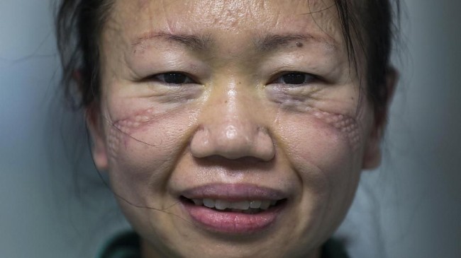 FOTO: Perkembangan Terkini Infeksi Virus Corona