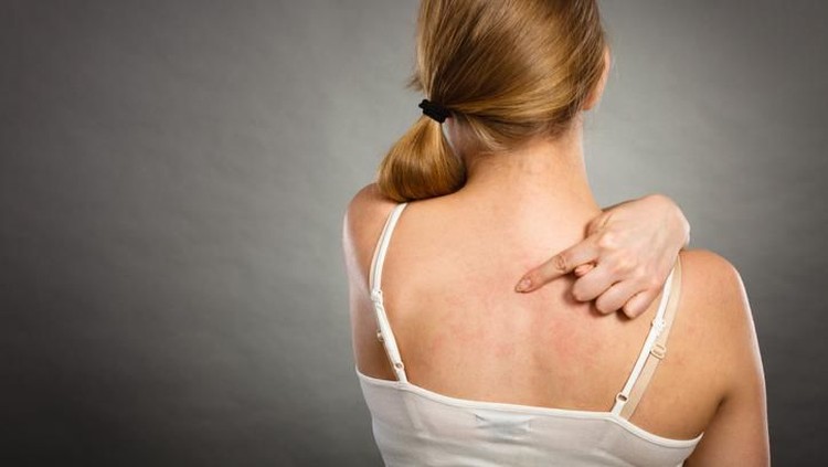 Health problem, skin diseases. Young woman showing her itchy back with allergy rash urticaria symptoms
