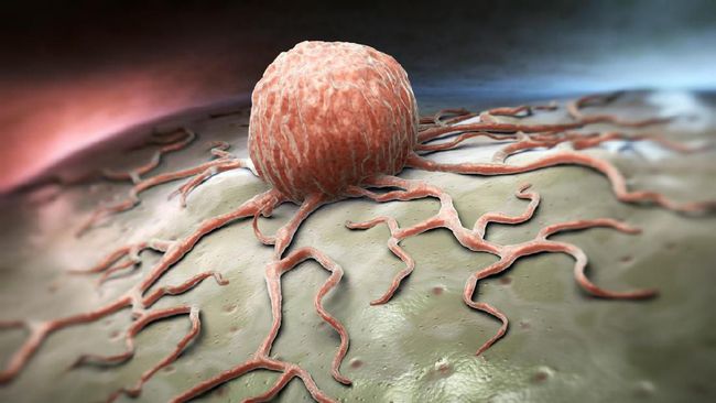 Sebagian orang masih gagap membedakan tumor dan kanker. Tumor kerap disamakan dengan kanker. Padahal dalam dunia medis, keduanya berbeda.