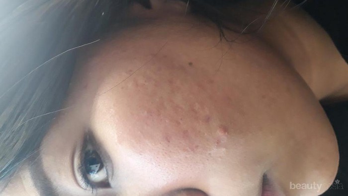 [FORUM] Berbagi Tips Menghilangkan Bekas Jerawat