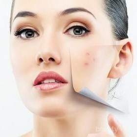Cara Menghilangkan Flek Hitam Bekas Jerawat dengan Cepat dan Mudah