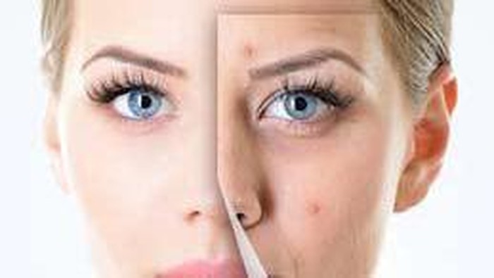 Cara Alami yang Ampuh Mengatasi Jerawat