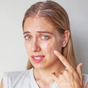 Lakukan 3 Cara Menghilangkan Bopeng Bekas Jerawat Ini dan Bikin Wajah Kembali Flawless