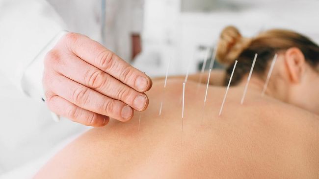 Pengobatan tradisional akupunktur disebut membantu proses pemulihan Covid-19. Pasalnya, pengobatan akupunktur disebut bisa meredakan stres pasca Covid-19.