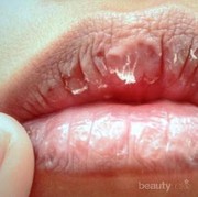[FORUM] Udah Pake Lip Balm Sampe Minum Banyak Air Putih tapi Bibir Masih Kering Tuh Gimana Ya?
