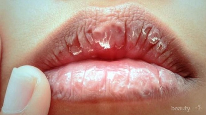 [FORUM] Udah Pake Lip Balm Sampe Minum Banyak Air Putih tapi Bibir Masih Kering Tuh Gimana Ya?