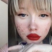 Sering dianggap Sepele, 5 Kebiasaan Ini Malah Memunculkan Bruntusan pada Kulit Wajah, Ladies!
