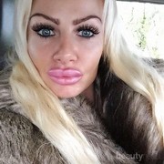 [FORUM] Bibir Wanita Ini Jontor karena Suntik Filler Dicampur Baby Oil, Hati-hati!