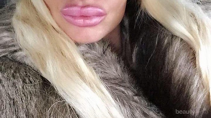 [FORUM] Bibir Wanita Ini Jontor karena Suntik Filler Dicampur Baby Oil, Hati-hati!