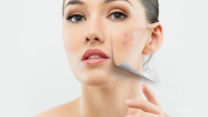 Mengatasi Jerawat Dengan Bahan Alami